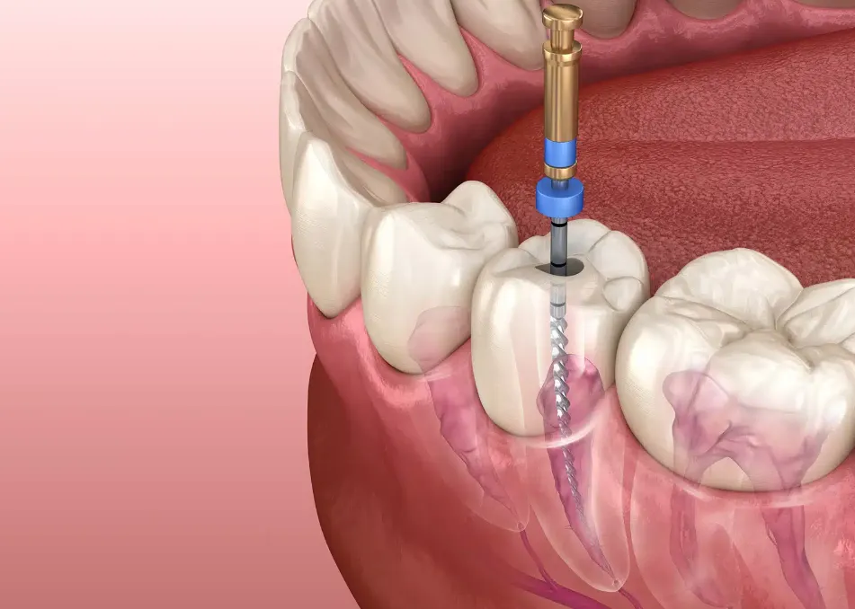 dental filling cost dental filling cost