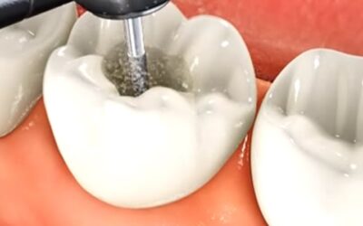 Top Dental Filling Near Me – Trusted Local Dentists