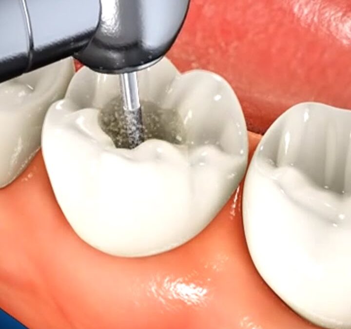 Top Dental Filling Near Me – Trusted Local Dentists