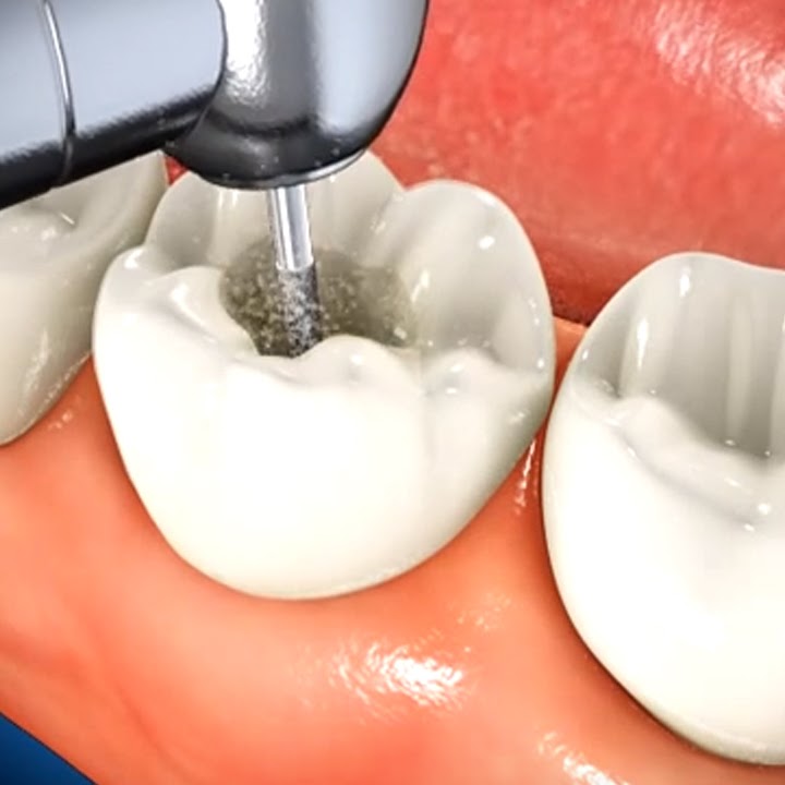 dental filling near me dental filling near me