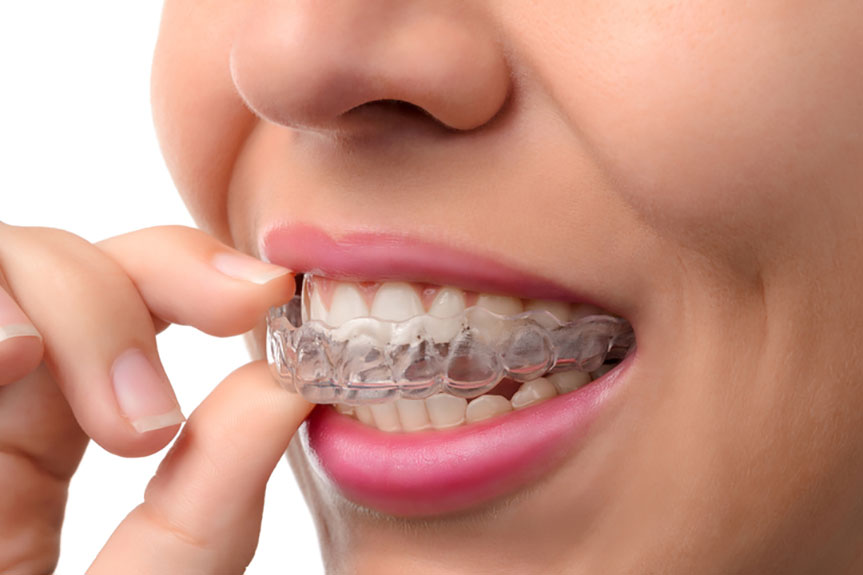 invisalign braces near me invisalign braces near me
