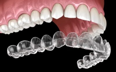 Find Invisalign Teeth Braces Near Me – Book a Free Consultation