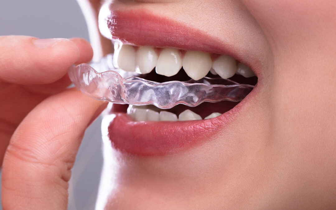 Invisalign Near Me: Your Complete Guide to Clear Aligner Treatment at Avon Dental Round Lake