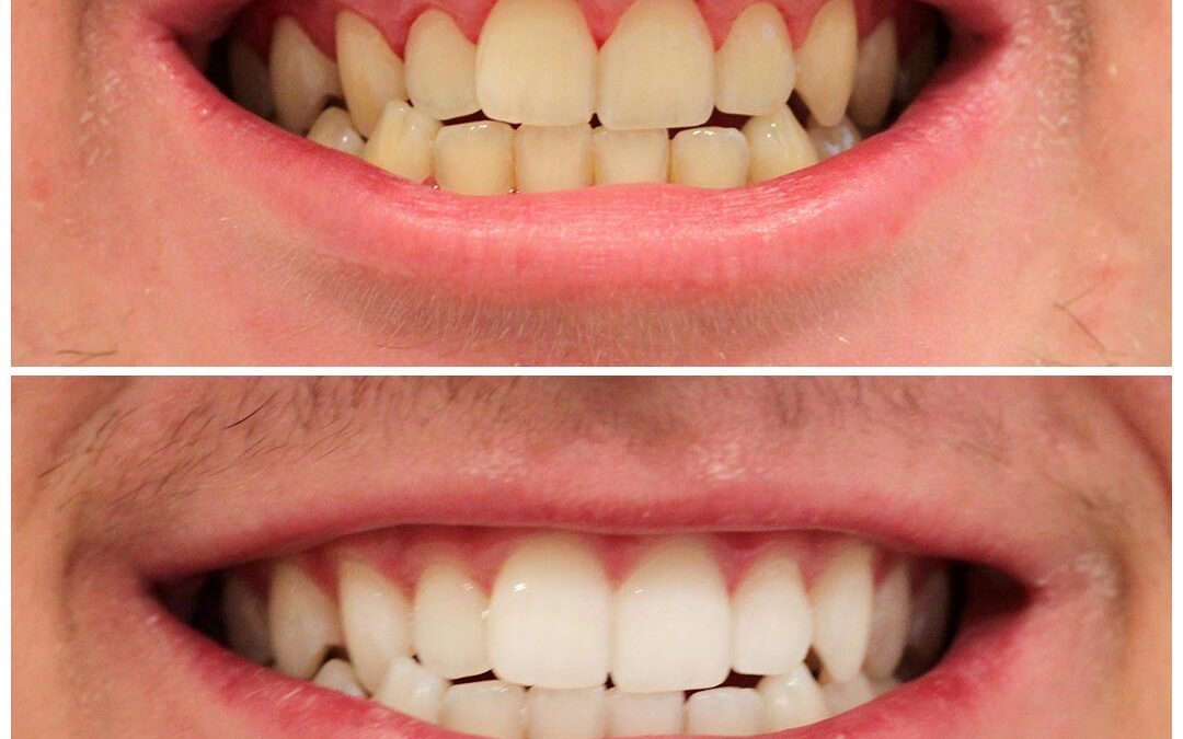Teeth Whitening Dentist Cost: What to Expect for a Brighter Smile
