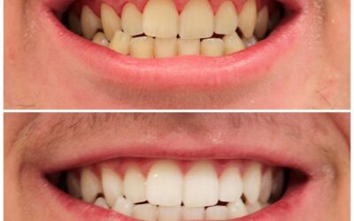 Teeth Whitening Dentist Cost: What to Expect for a Brighter Smile