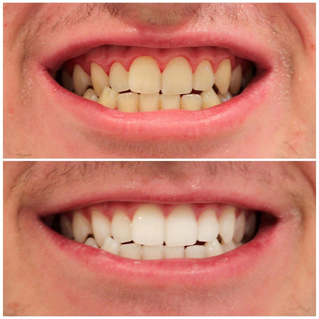 teeth whitening dentist cost teeth whitening dentist cost