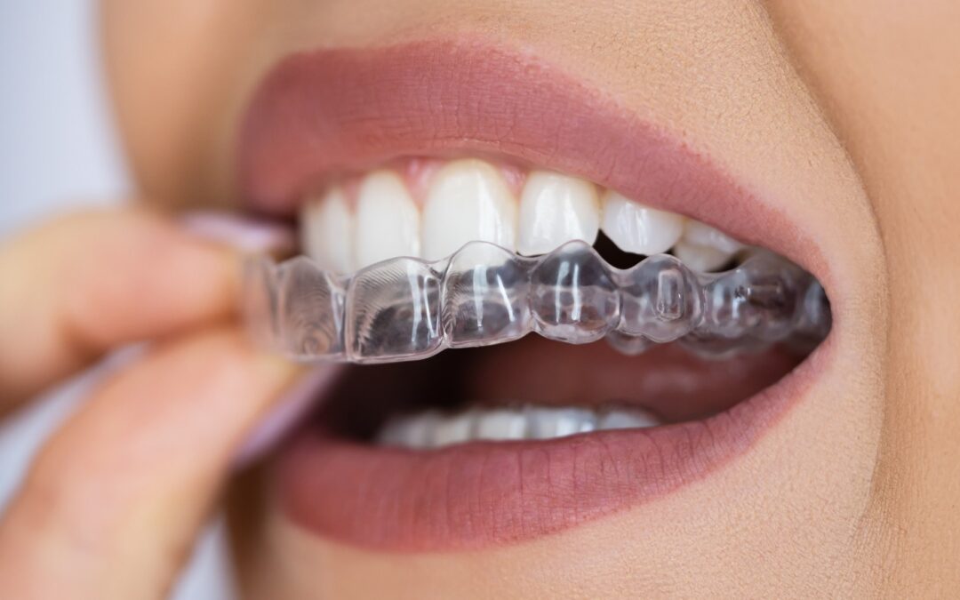 The Complete Guide to Transparent Braces: A Discreet Path to a Perfect Smile