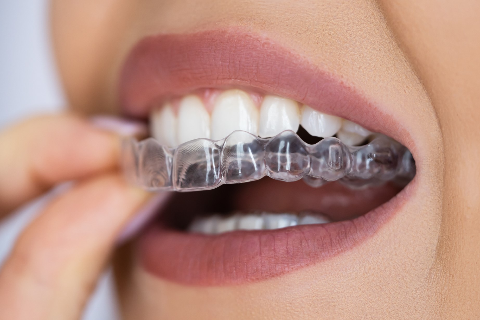 transparent braces transparent braces