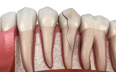 Cracked Teeth: Causes, Symptoms & Best Treatment Options