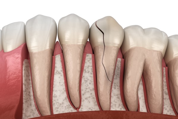 cracked teeth cracked teeth