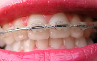 Finding the Best Damon Braces Near Me: Your Complete Guide