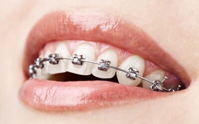 A Modern Approach to a Perfect Smile: Understanding Damon System Braces