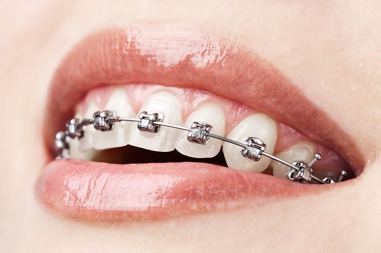 damon system braces damon system braces