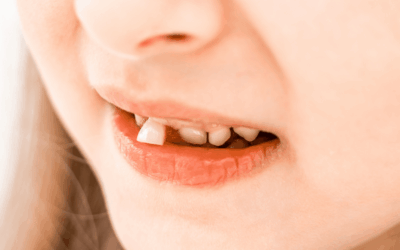 Knocked Out Tooth? Save It Fast – Emergency Steps!