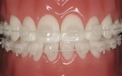 Ceramic Braces: Discreet & Effective Teeth Straightening