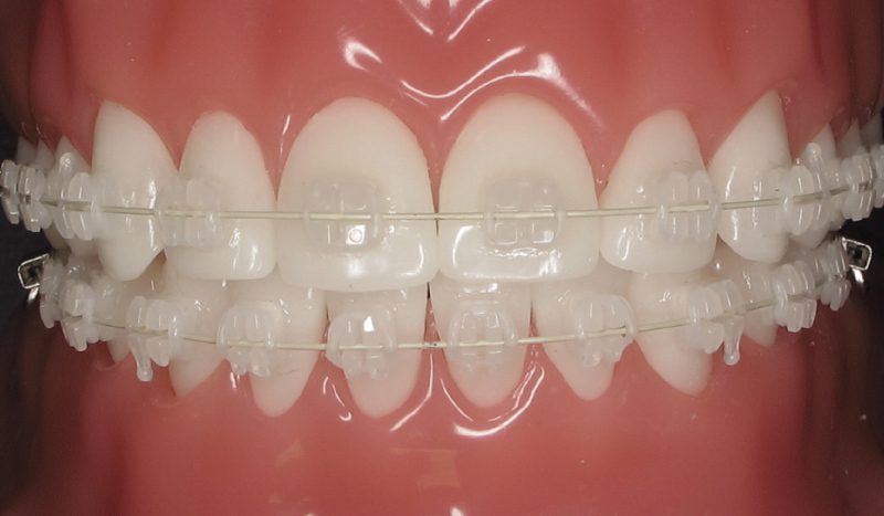 ceramic braces featured image