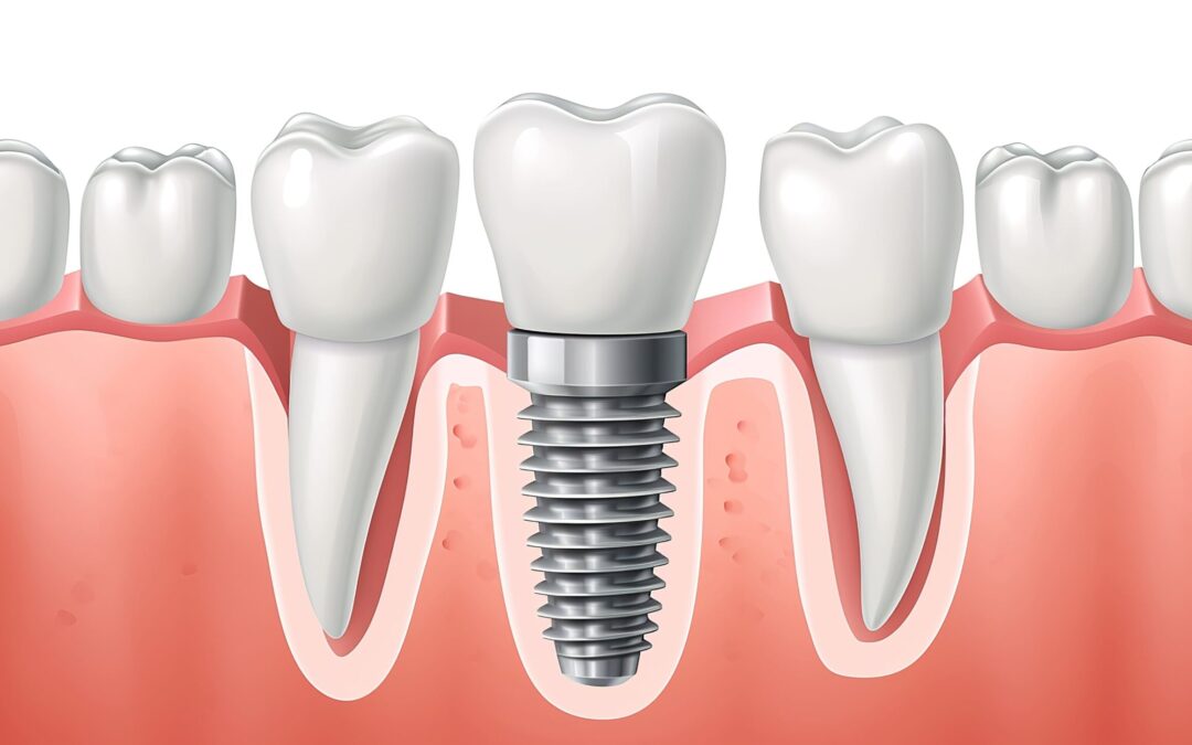 Dental Implants: A Permanent Solution for Missing Teeth