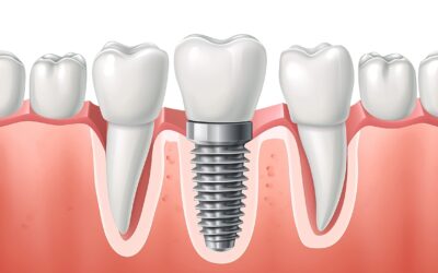 Dental Implants: A Permanent Solution for Missing Teeth