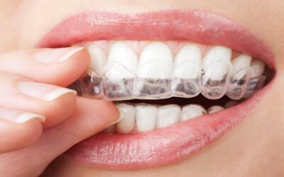 Transparent Braces: The Clear & Discreet Path to a New Smile