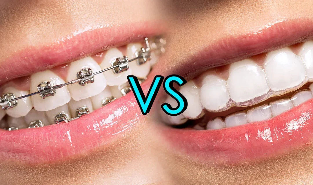 Invisalign vs. Braces: Compare Cost, Time, & Effectiveness