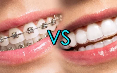 Invisalign vs. Braces: Compare Cost, Time, & Effectiveness