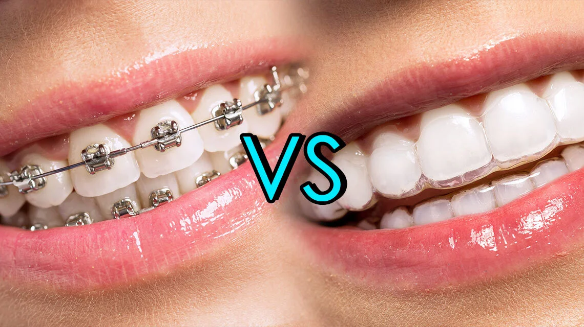 braces vs invisalign featured image