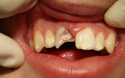 Broken Tooth Pain: What to Do Now & How to Fix It