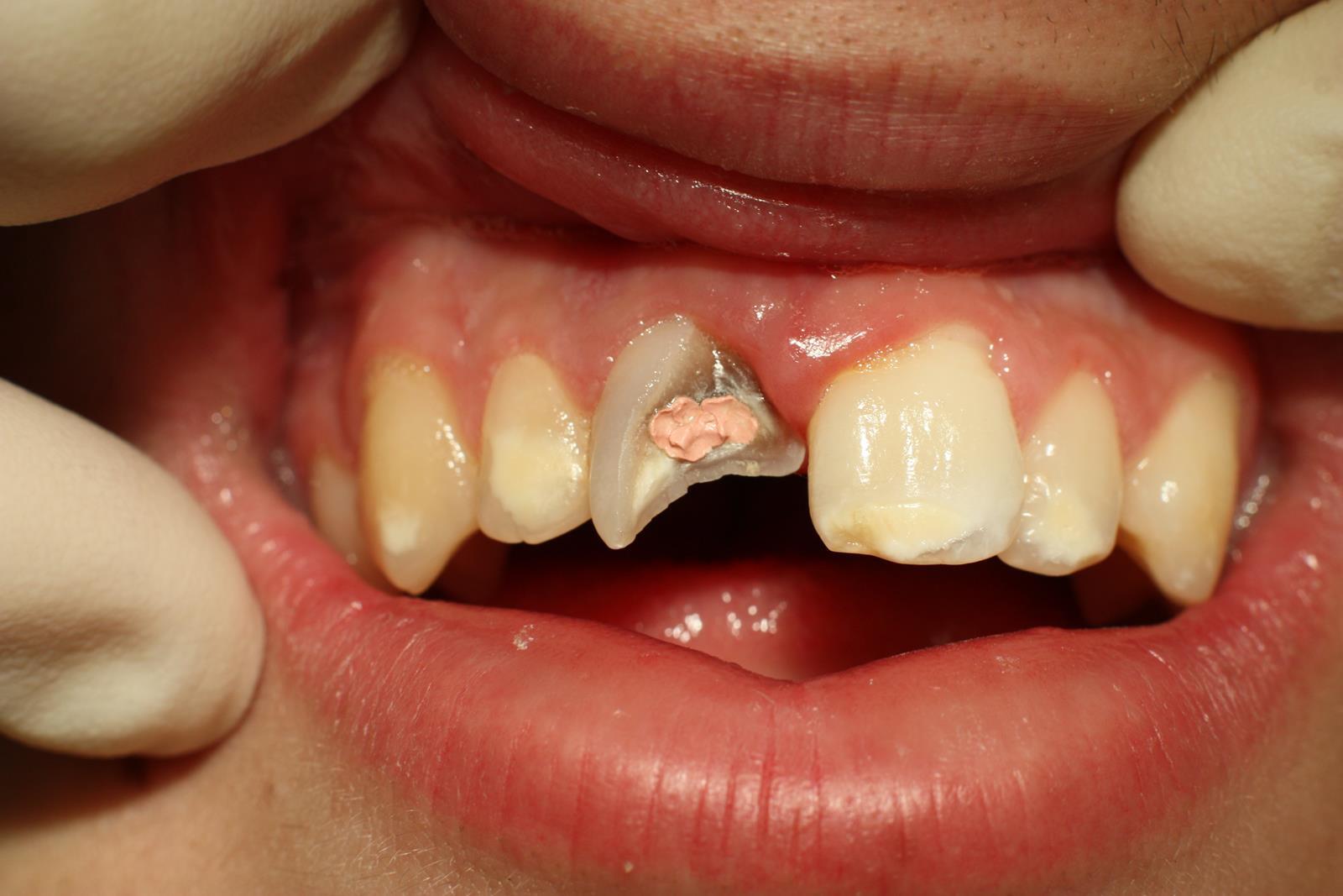 broken tooth pain featured image