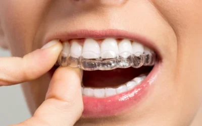 Invisalign Braces Pricing for a Confident, Straight Smile
