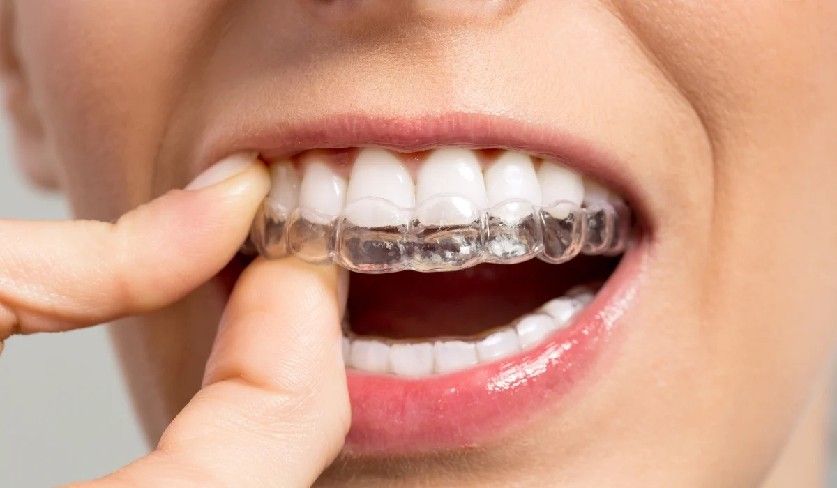 invisalign braces pricing featured image