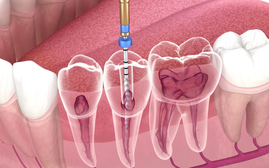 Affordable Root Canal | Quality Care at Prices You Can Afford
