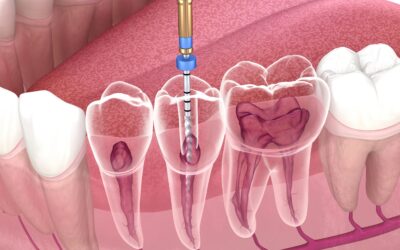 Affordable Root Canal | Quality Care at Prices You Can Afford