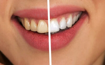 Professional Laser Teeth Whitening | Get a Brighter Smile Today