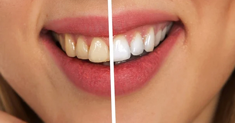 Professional Laser Teeth Whitening | Get a Brighter Smile Today