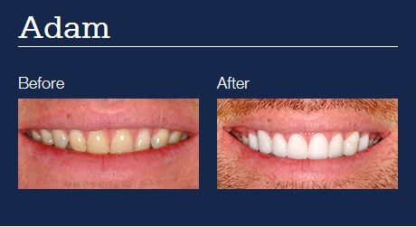 before and after dental veneers adam