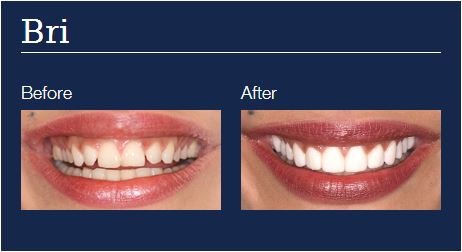 before and after dental veneers one
