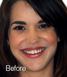 dental veneers before shot of girl one